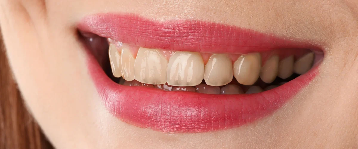 dental-before